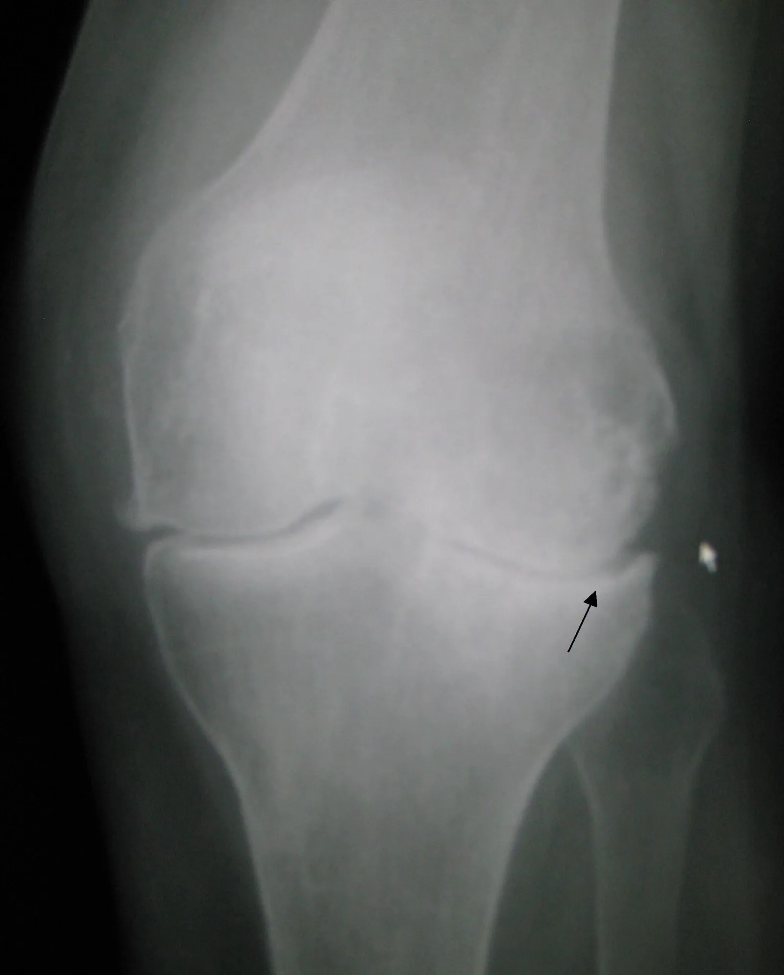 Radiografia di un ginocchio con osteoartrosi